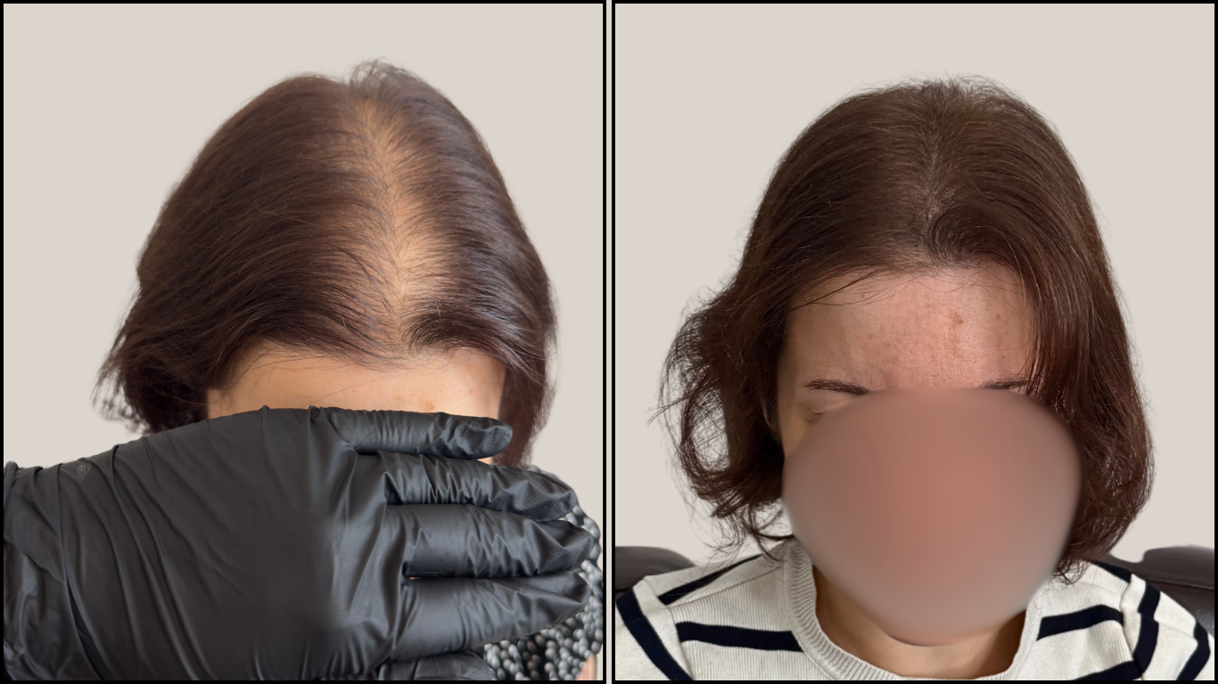 Résultat récent d'effet densité femme sur la raie, avant et après