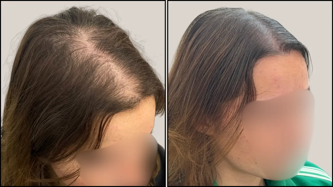 Effet densité femme : comparaison avant et après sur la raie