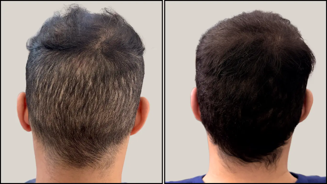 Zone donneuse à l'arrière du crâne, avant et après micropigmentation