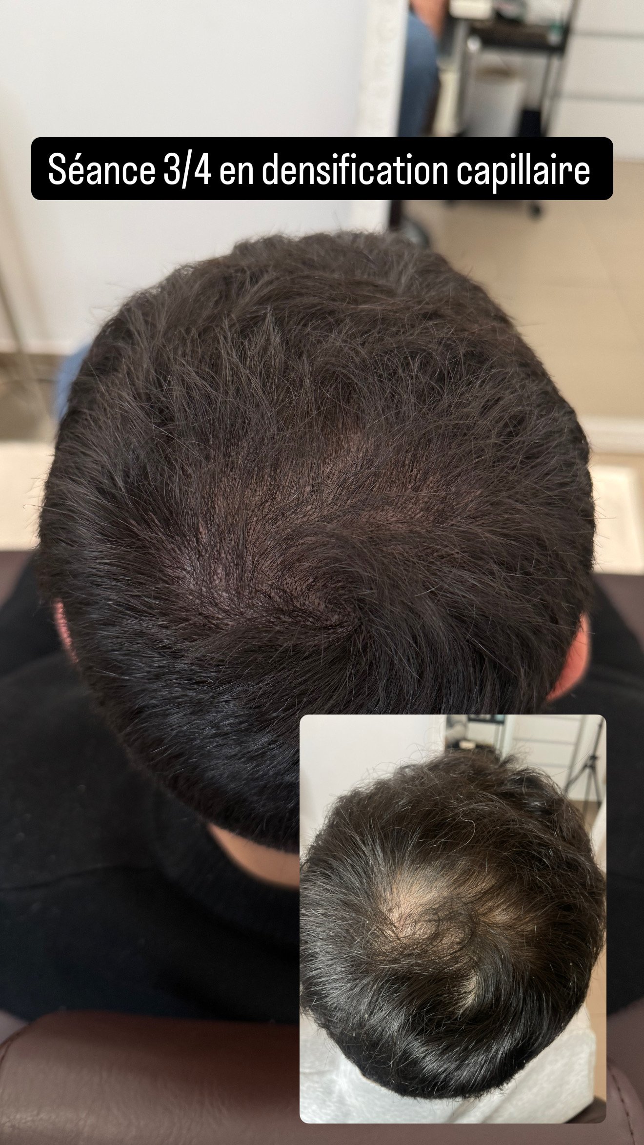 Effet densité homme : vertex après la 3e séance, photo avant en médaillon