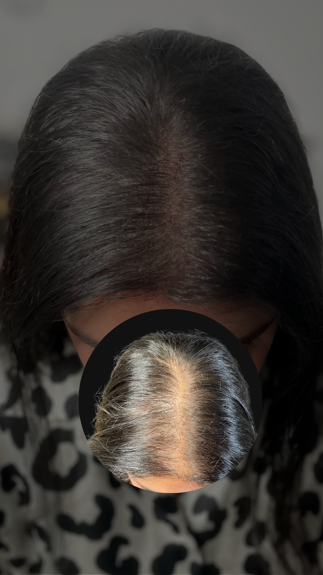 Effet densité femme : résultat réel sur le sommet du crâne, photo avant en médaillon